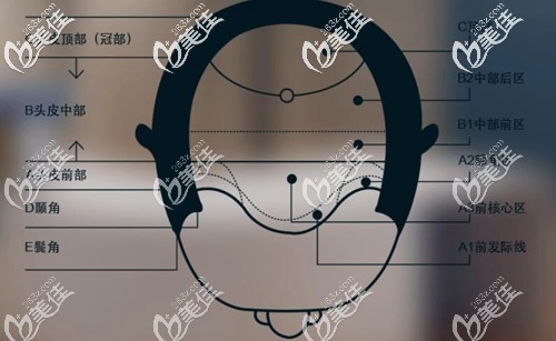 不同的脱发部位采取个性化种植 不同的脱发部位采取个性化种植