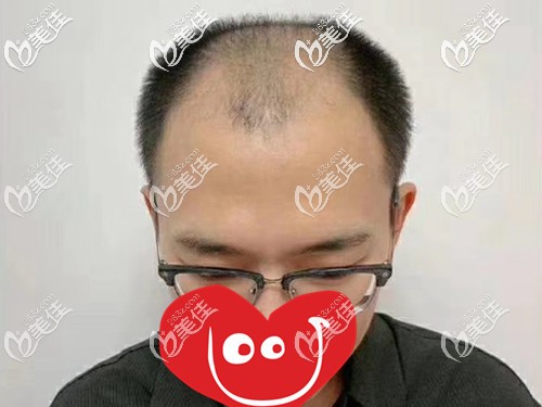 植发前头顶大面积脱发 植发前头顶大面积脱发