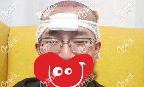 刚做完植发手术后的效果 刚做完植发手术后的效果