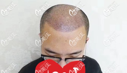 术后第五天清理了头部血痂 术后第五天清理了头部血痂