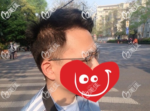 我多年雄脱造成额角光秃、头顶大面积稀疏，经BHT2.0大面积植发+稀疏加密后变这样...