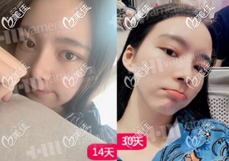 做眼鼻整形一个月内的变化效果照