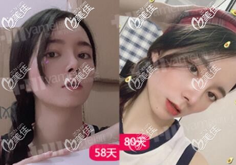 在长沙做眼鼻整形2个月左右的变化效果照