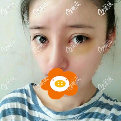 术后一周拆线还有点肿