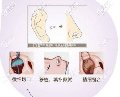 鼻翼缺损再造图片