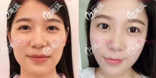 衡阳雅美面部微整形真人前后对比效果照片 衡阳雅美面部微整形真人前后对比效果照片