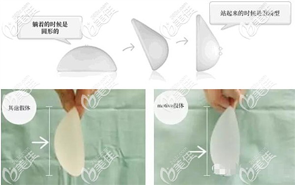 motiva隆胸假体优势