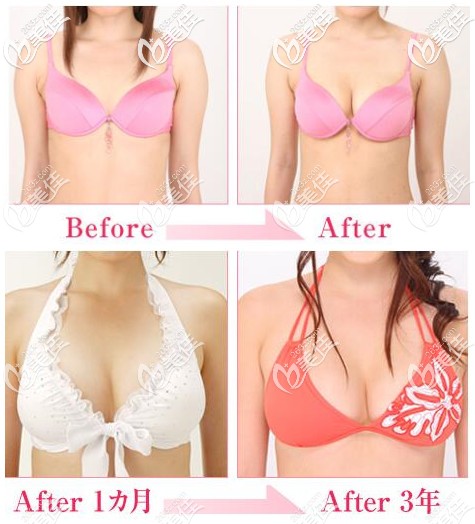 岛仓康人隆胸对比案例