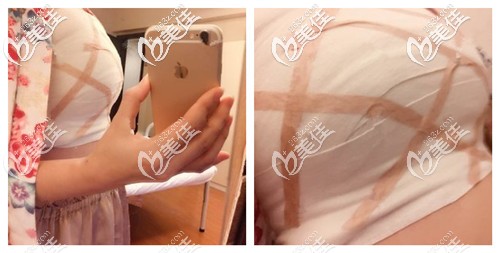 刚做完自体脂肪丰胸手术胸部变大