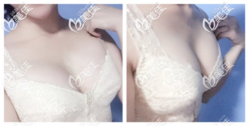 自体脂肪丰胸术后1个月胸部微肿胀