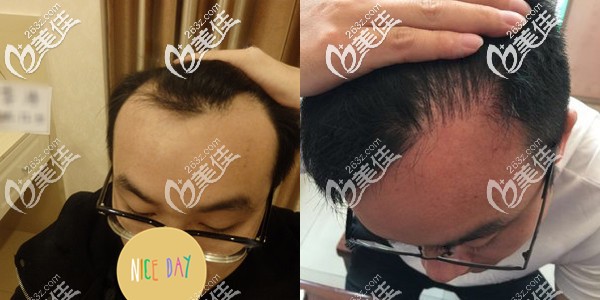 北京碧莲盛袁国安发际线种植效果图 北京碧莲盛袁国安发际线种植效果图