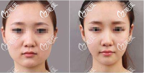 面部吸脂六个月后恢复效果