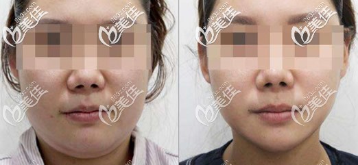 双下巴吸脂前后对比照片