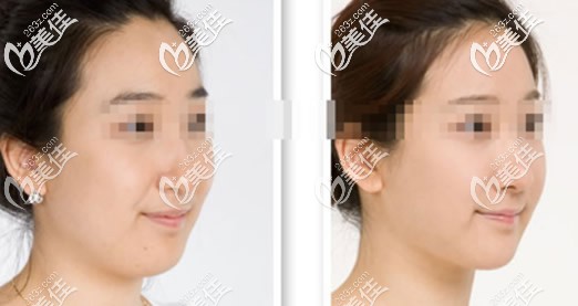 双下巴吸脂效果怎么样