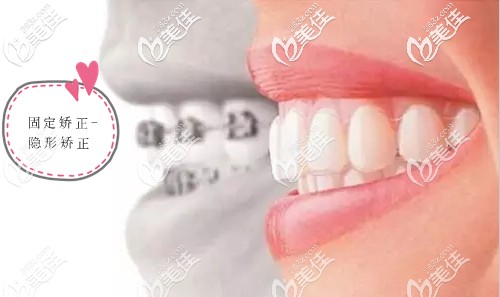 谭杰医生擅长青少年及成人错颌畸形矫治 谭杰医生擅长青少年及成人错颌畸形矫治