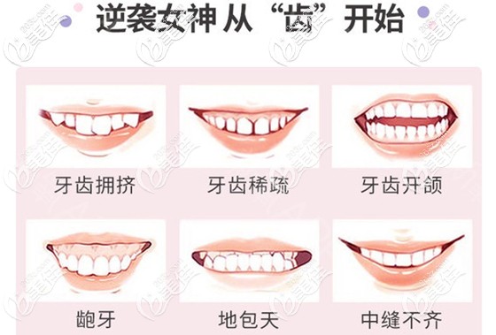 想颜值逆袭就从牙齿矫正开始吧 想颜值逆袭就从牙齿矫正开始吧