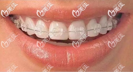 冰晶自锁托槽矫正仅需14800元起 冰晶自锁托槽矫正仅需14800元起
