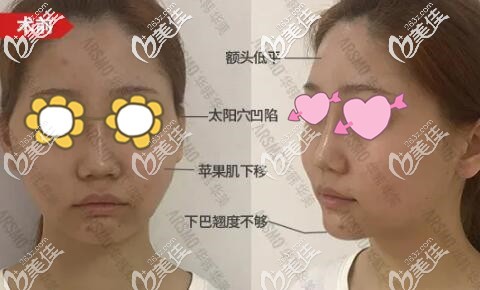 在长沙做面部脂肪填充术前照 在长沙做面部脂肪填充术前照