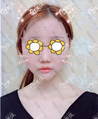 做完面部脂肪填充术后2天恢复照 做完面部脂肪填充术后2天恢复照