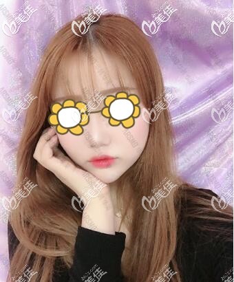 自体脂肪填充面部一周时的恢复效果图 自体脂肪填充面部一周时的恢复效果图