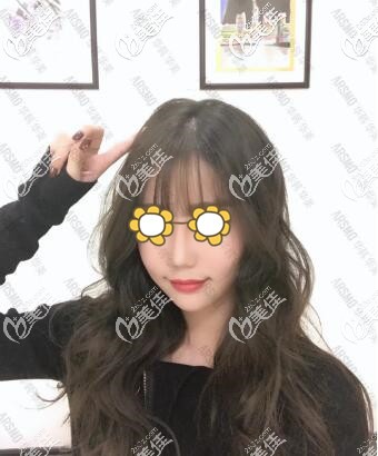 长沙华韩华美真人脂肪面部填充术后15天照 长沙华韩华美真人脂肪面部填充术后15天照