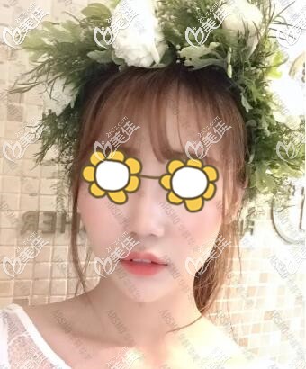 长沙华韩华美真人自体脂肪填充面部术后30天恢复效果图 长沙华韩华美真人自体脂肪填充面部术后30天恢复效果图