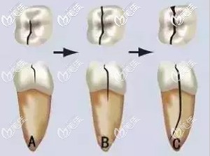 牙隐裂的从浅表到牙根的发展图 牙隐裂的从浅表到牙根的发展图