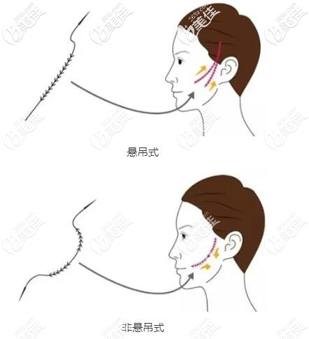大V埋线提升分为悬吊式和非悬吊式 大V埋线提升分为悬吊式和非悬吊式