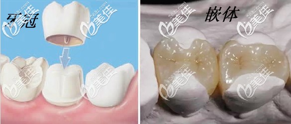 牙齿修复选嵌体和牙冠的示意图 牙齿修复选嵌体和牙冠的示意图