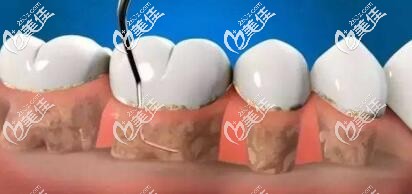 洗牙龈下刮治 洗牙龈下刮治