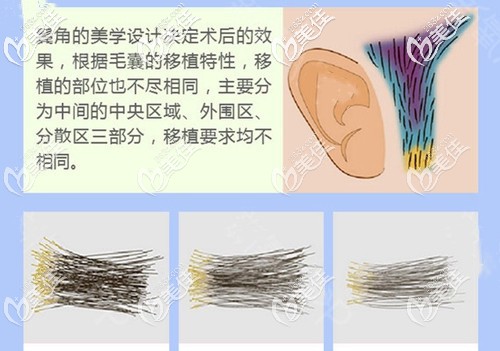 艺术毛囊移植鬓角手术 艺术毛囊移植鬓角手术