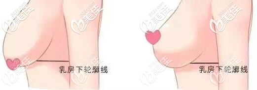 乳房下垂和乳房下移的区别