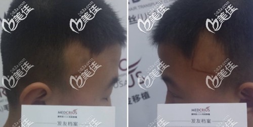 男士天生鬓角缺失 男士天生鬓角缺失