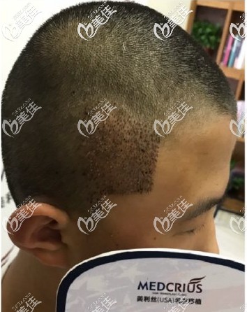 天生鬓角缺失,植鬓角后即刻效果图 天生鬓角缺失,植鬓角后即刻效果图