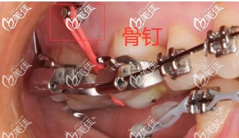 正畸打骨钉 正畸打骨钉