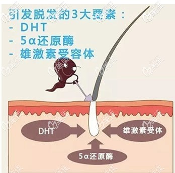 造成雄性脱发的主要原因 造成雄性脱发的主要原因