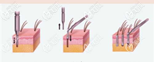 眉毛种植的过程原理 眉毛种植的过程原理