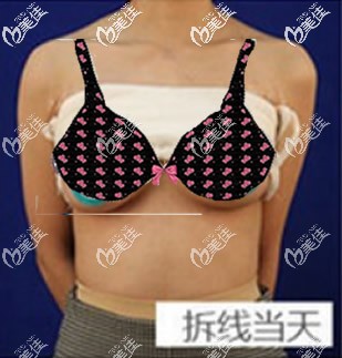傲诺拉璀璨水滴形假体丰胸拆线后效果