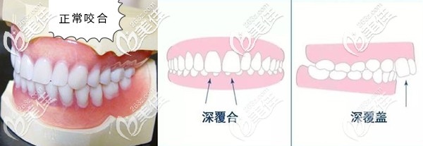深覆合和深覆盖的区别对比图