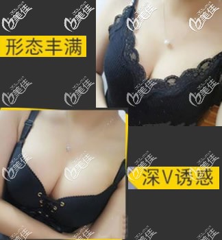 傲诺拉隆胸半年后恢复图