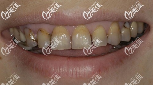 我的四环素牙 我的四环素牙