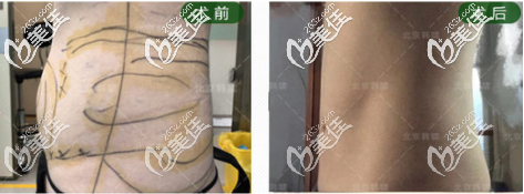 北京韩啸医疗美容门诊部腰腹减脂真人案例