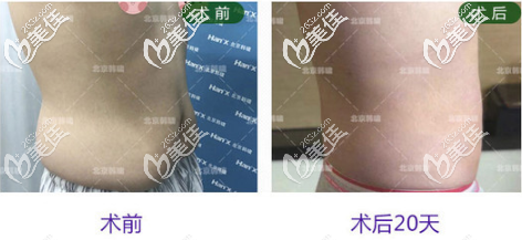 北京韩啸腰腹吸脂真人案例