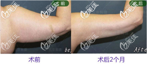 北京韩啸手臂吸脂真人案例