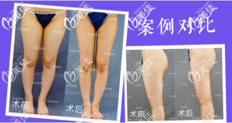 北京韩啸大腿吸脂真人案例