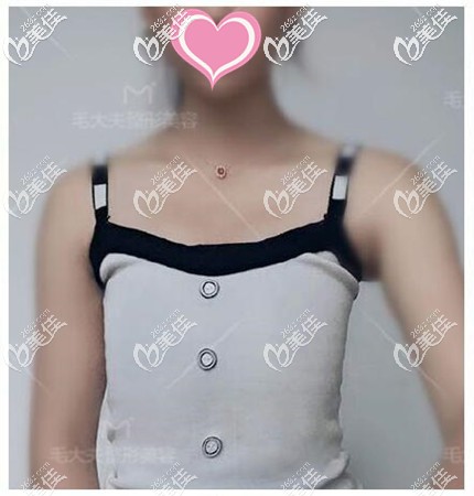 假体隆胸手术前 假体隆胸手术前