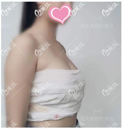 假体隆胸手术恢复期 假体隆胸手术恢复期