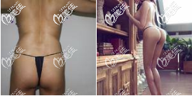 北京禾美嘉自体脂肪丰臀真人案例