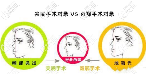 突嘴手术和双鄂手术的区别 突嘴手术和双鄂手术的区别
