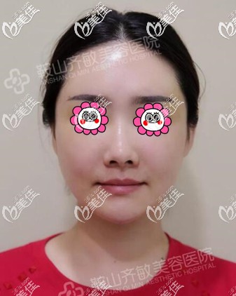 自体脂肪填充面部1个月时的<span style=